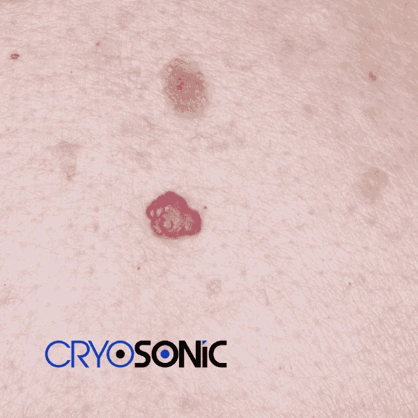 Looking for pain free cherry angioma removal treatment Bracknell? Call our team today! Bracknell