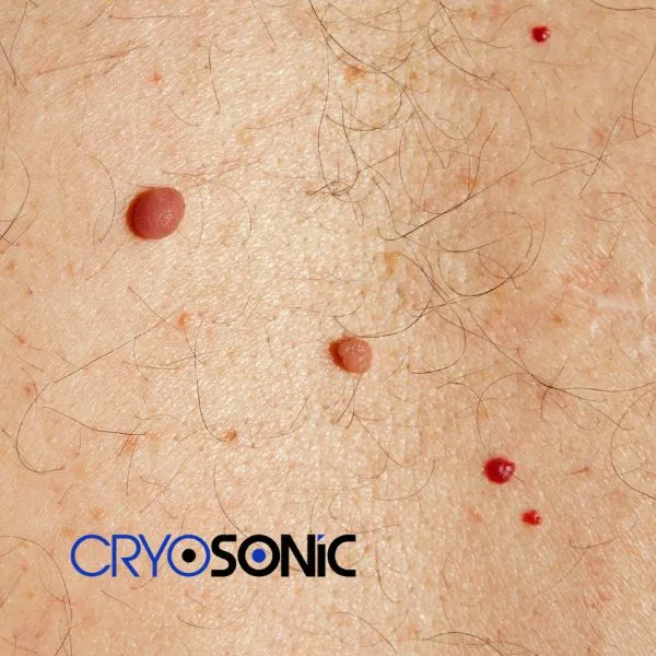 get cherry angioma removal treatment today! Bracknell