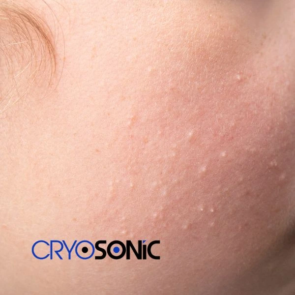 Are you looking for milia removal treatment? Contact our team today Bracknell
