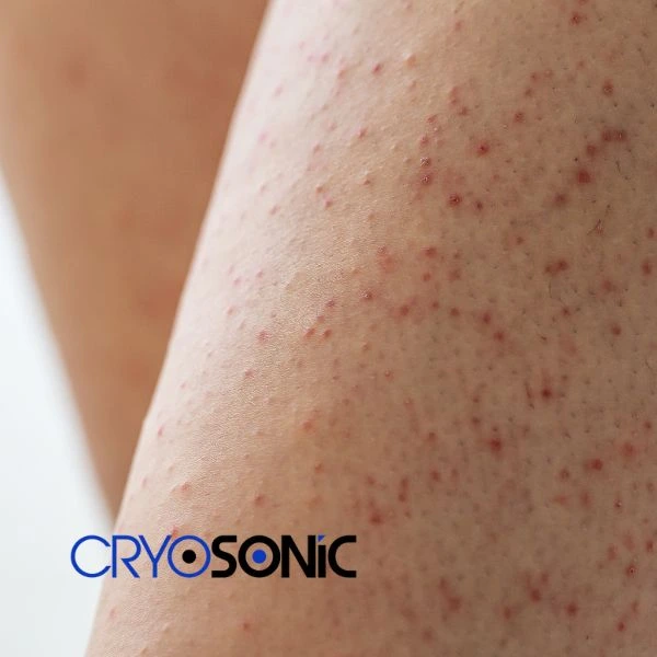 Looking for Seborrhoeic Keratosis removal Bracknell treatment? Call our consultants today in Bracknell