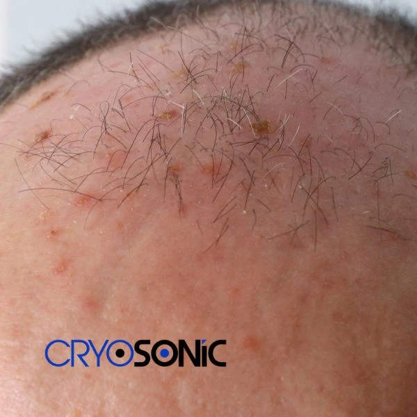 Access Seborrhoeic Keratosis removal from the comfort of your own home! Call us today in Bracknell