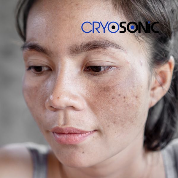 Ready to start age spots removal? Contact our team today in Bracknell