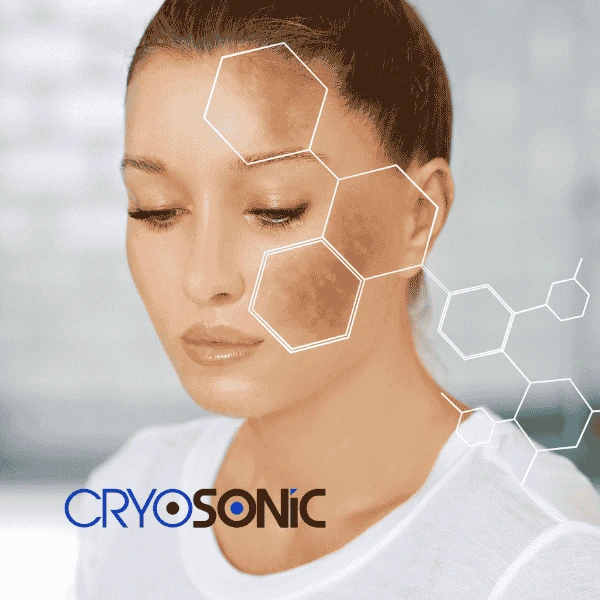 Are you looking for age spot removal treatment? Contact Cryosonic today in Bracknell