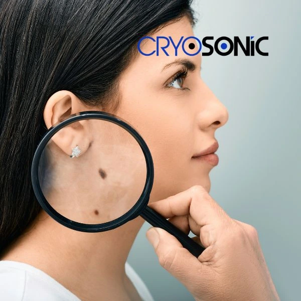 Do you want to learn more about benign moles removal treatment? Call our team today Bracknell