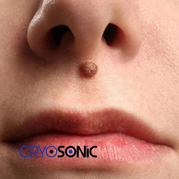 Start your benign moles removal treatment today Bracknell