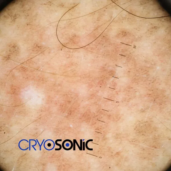 Speak to our team today about sun damaged skin treatment today in Bracknell