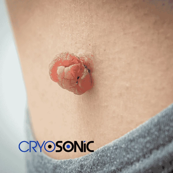 Book your skin tags removal Bracknell from comfort of your own home! Bracknell