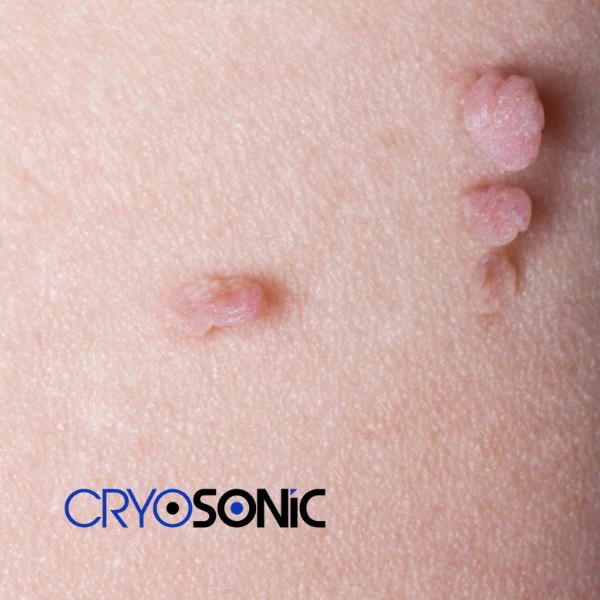 Are you looking for fast effect skin tag removal Bracknell? Book in NOW! Bracknell