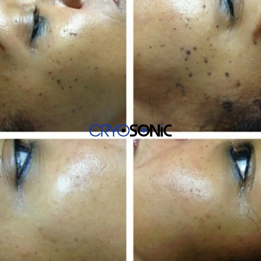 Why Skin Shows Pigmentation After Treatment Bracknell