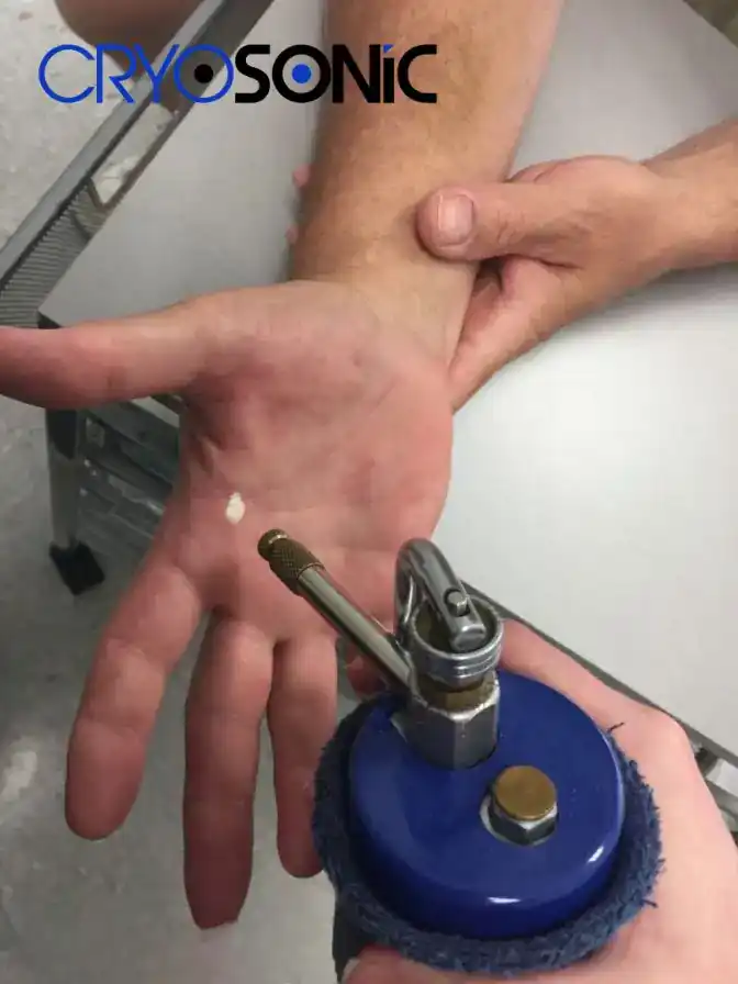 Temperature Differences: OTC vs Medical-Grade Cryotherapy Bracknell
